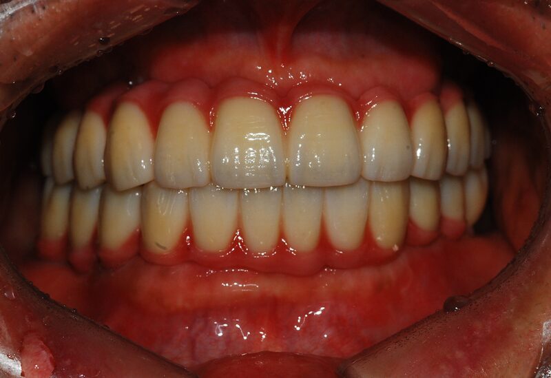 Case 1 After